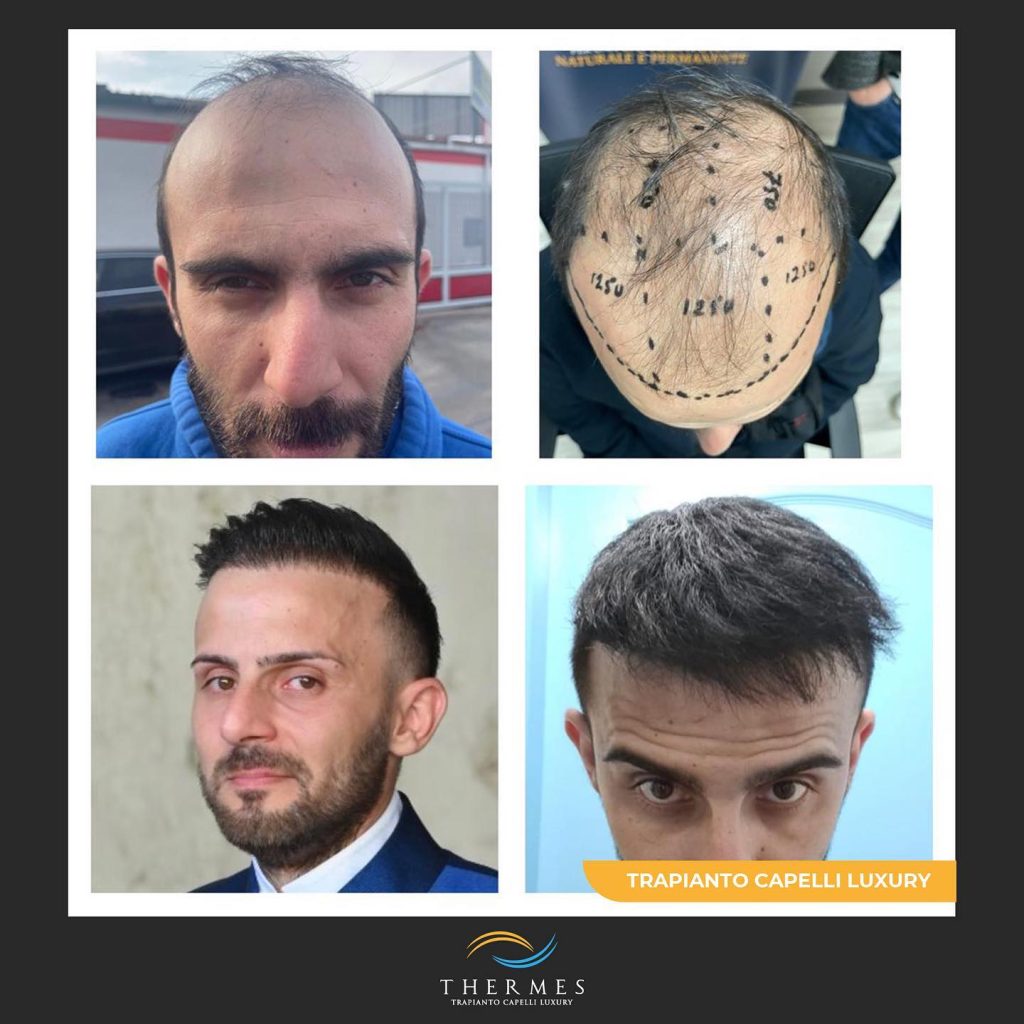 trapianto capelli turchia thermes